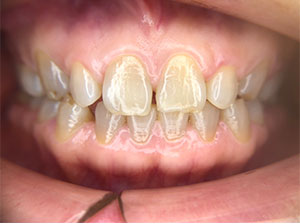 セラミック症例