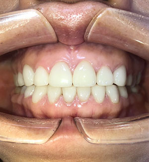 セラミック症例